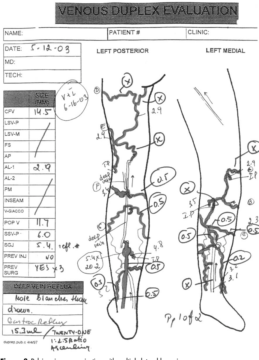 Management Of Venous Malformations In Klippel Trenaunay Syndrome With Ultrasound Guided Foam Sclerotherapy Semantic Scholar DVT Ultrasound Made Easy Step By Step Guide POCUS 101